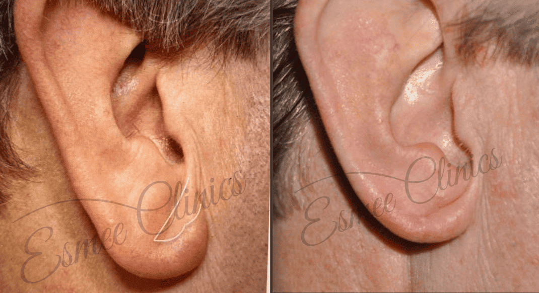Before and After img